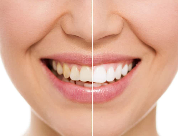 Blanchiment des dents à la clinique dentaire Revival
